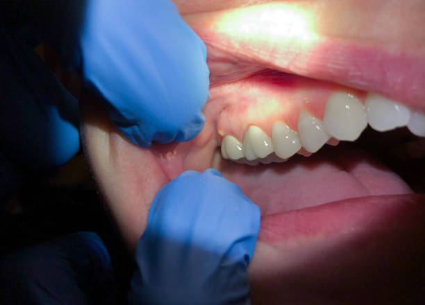 Best Emergency Treatment for Oral Infections in Village Green, NY